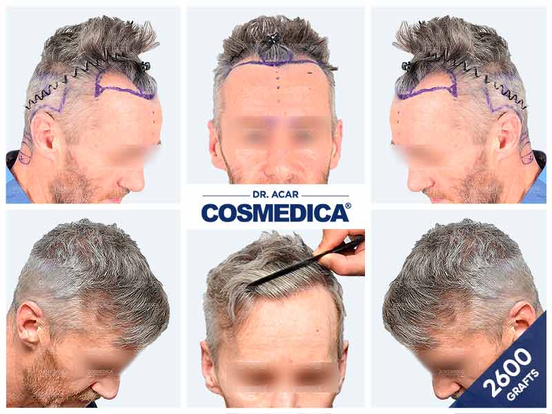 2 600 графтов — результат пересадки волос в клинике Cosmedica