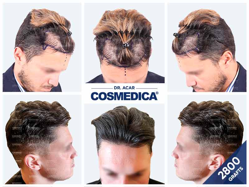 2 800 графтов — результат пересадки волос в клинике Cosmedica