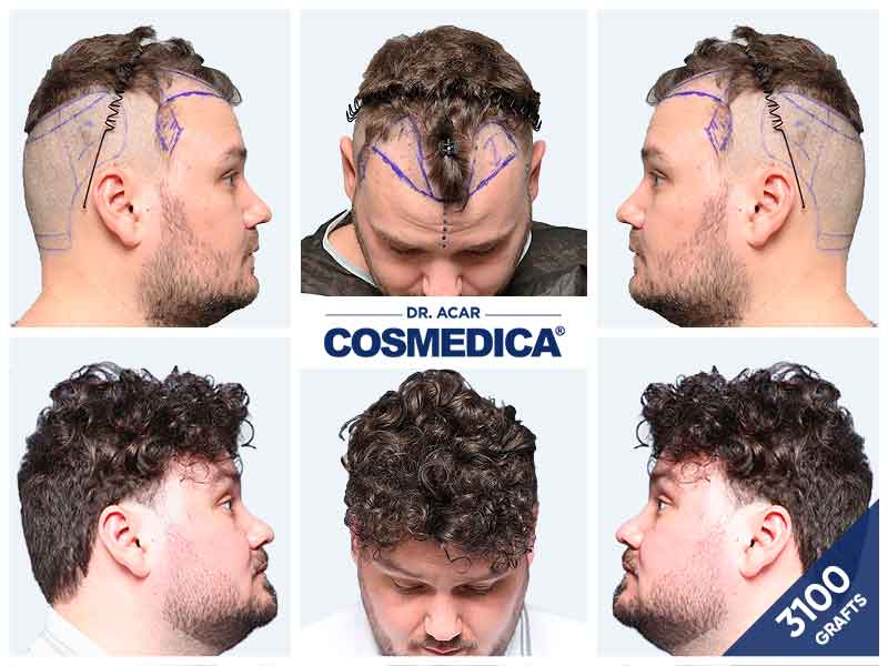 3 100 графтов — результат пересадки волос в клинике Cosmedica