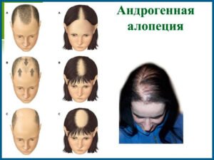 С какого возраста можно делать пересадку волос