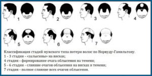Выпадение волос у мужчин